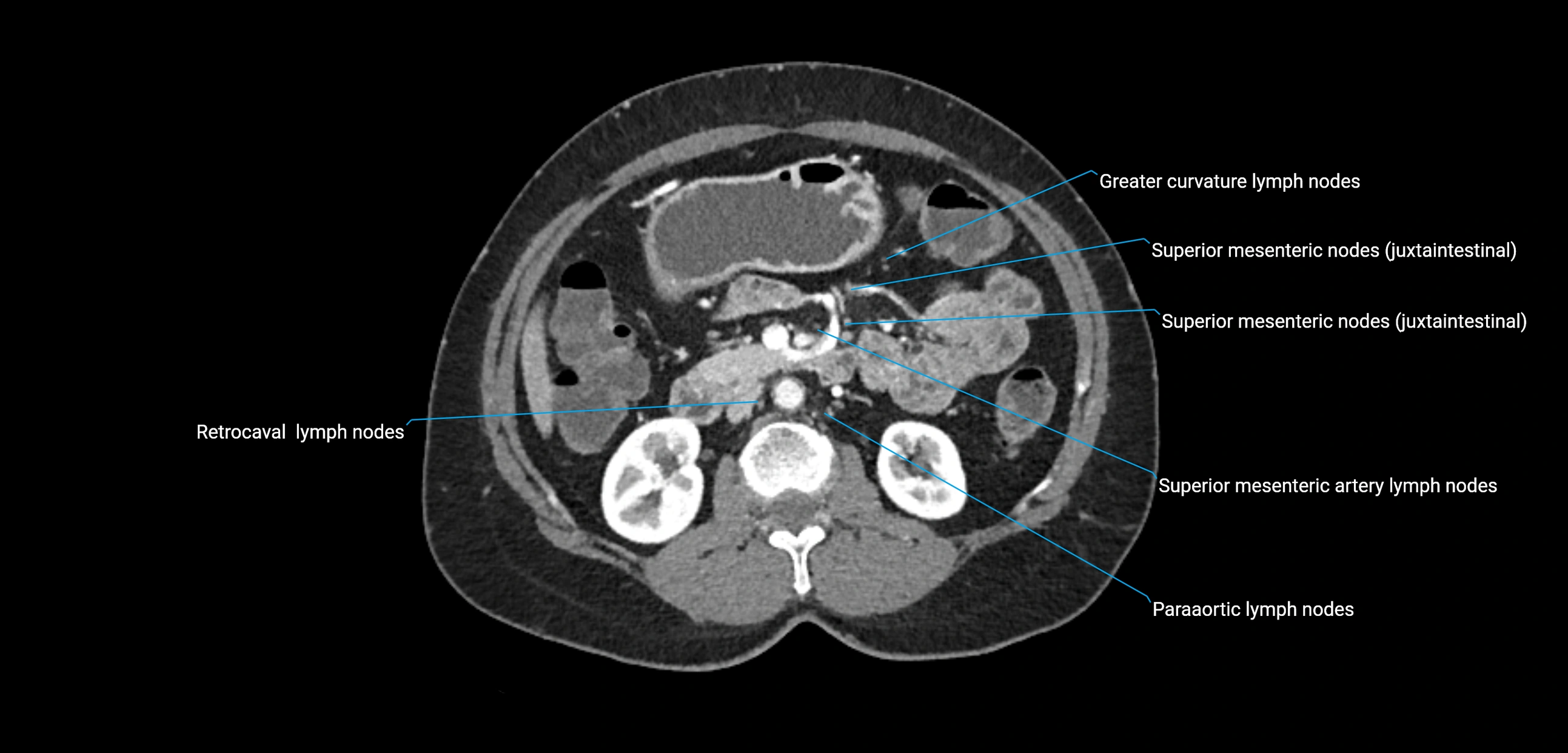 CT ct abdominal lymph nodes  axial cross sectional anatomy  enchanced radiology image -img-00002-00192.webp